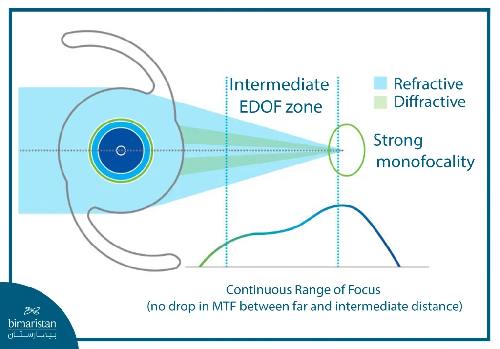 Illustration Showing The Mechanism Of Action Of An Extended Depth Of Focus (Edof) Intraocular Lens, Demonstrating A Continuous Range Of Focus Between Distance And Intermediate Vision.