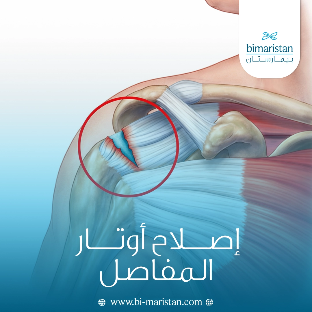 إصلاح أوتار المفاصل