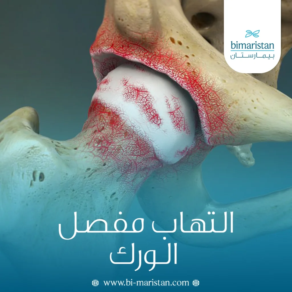 التهاب مفصل الورك