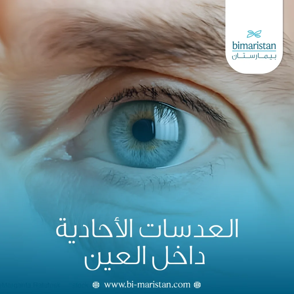 العدسات الأحادية داخل العين: المميزات والعيوب ومتى تُعد الخيار الأفضل؟ 5 العدسات الأحادية داخل العين