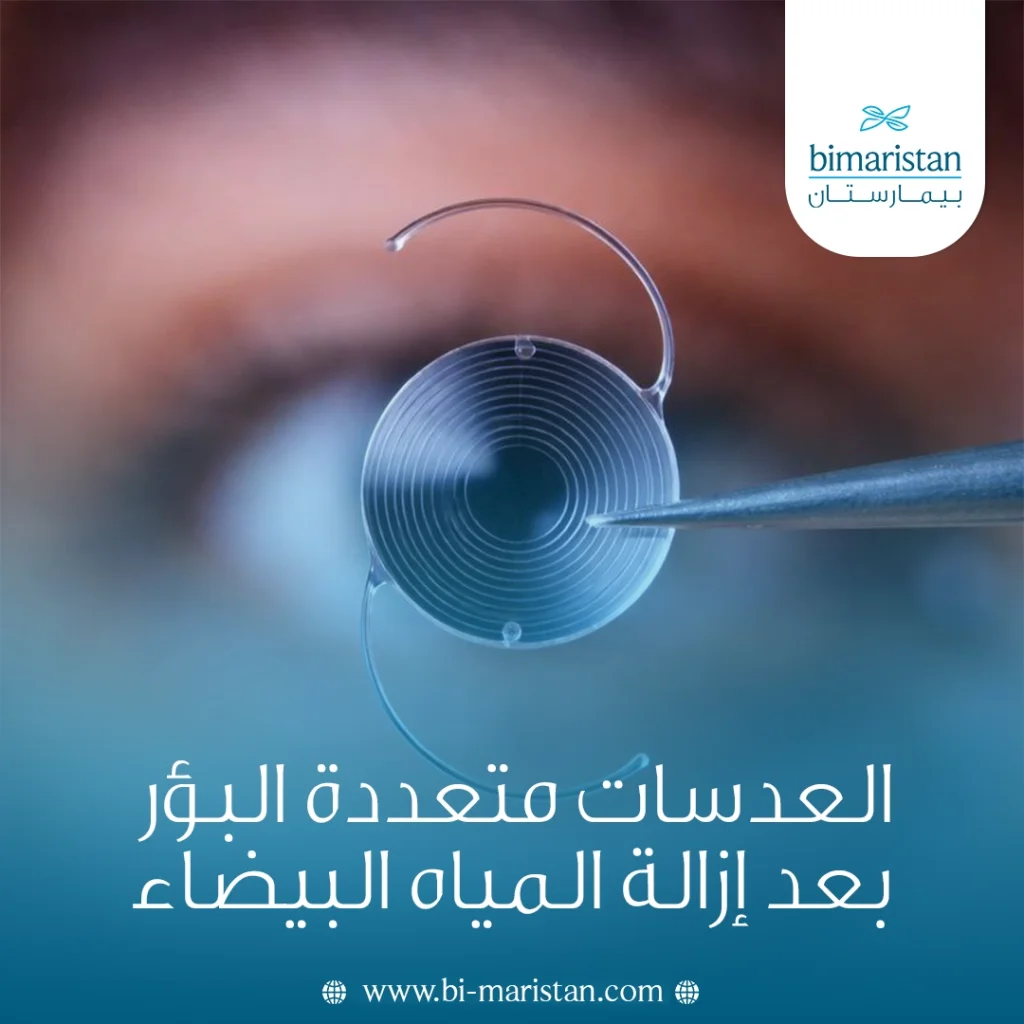 العدسات متعددة البؤر بعد إزالة المياه البيضاء