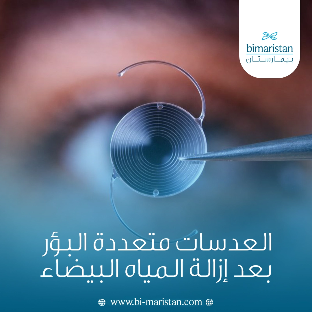 العدسات متعددة البؤر بعد إزالة المياه البيضاء