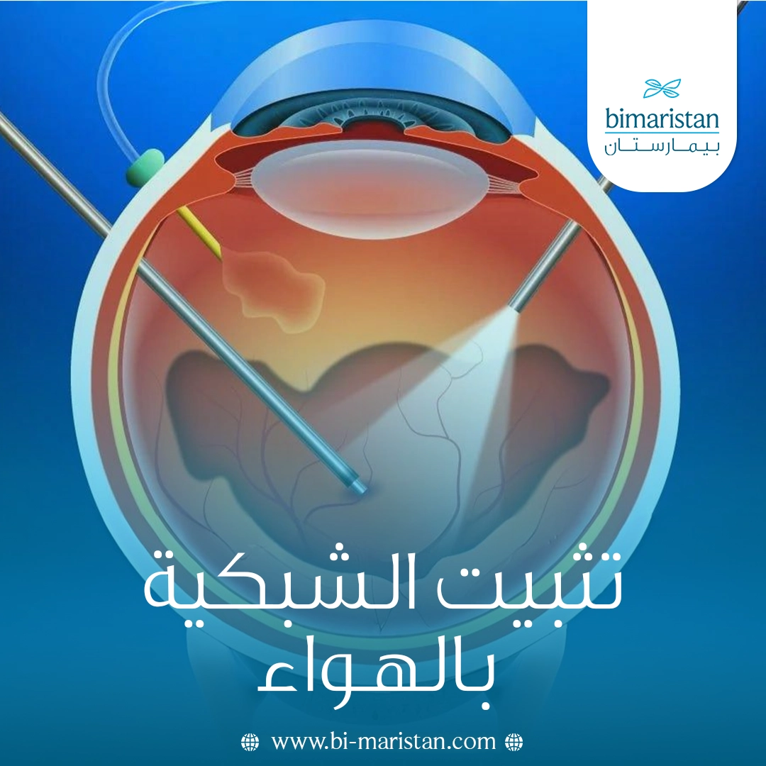 تثبيت الشبكية بالهواء