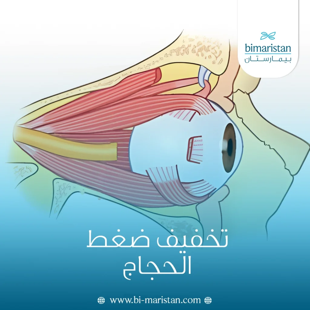 تخفيف ضغط الحجاج