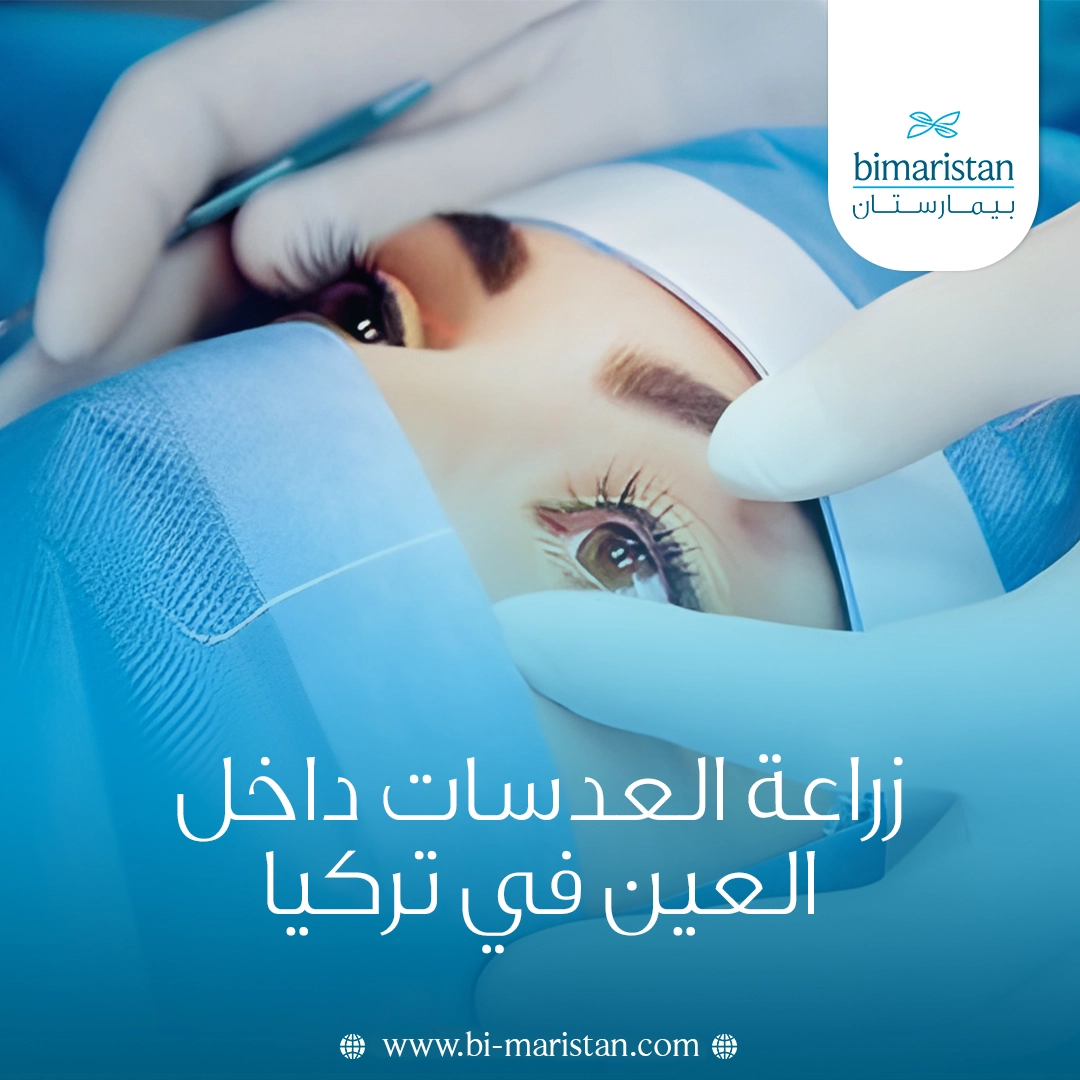 زراعة العدسات داخل العين في تركيا