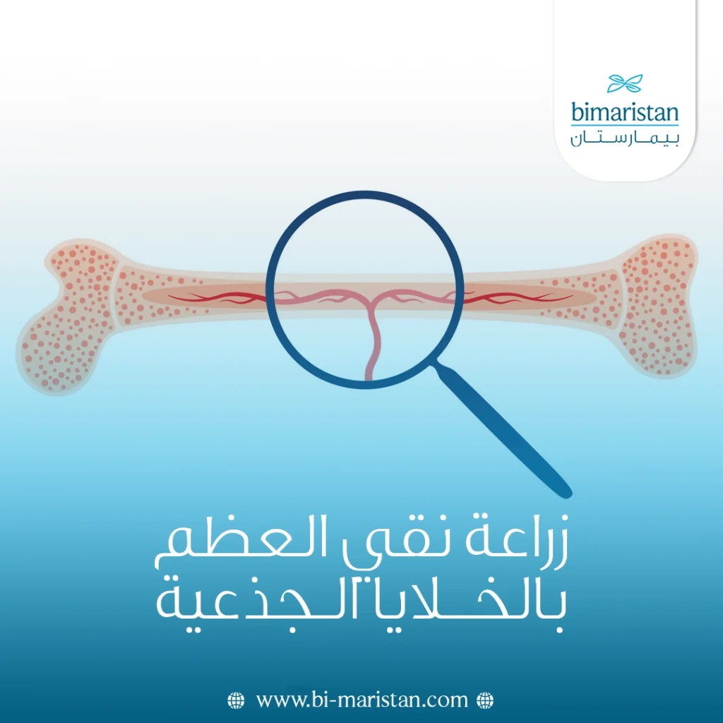 زراعة نقي العظم بالخلايا الجذعية