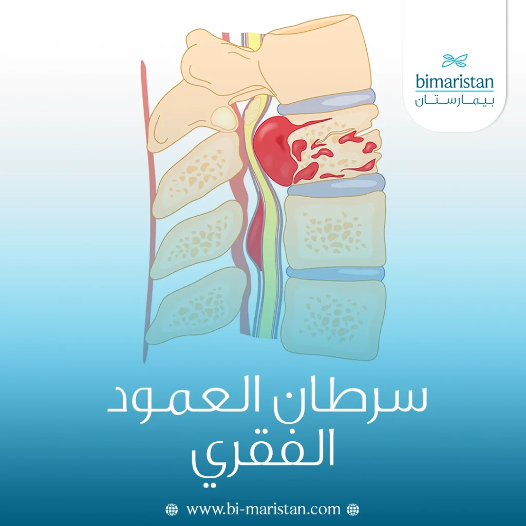 سرطان العمود الفقري