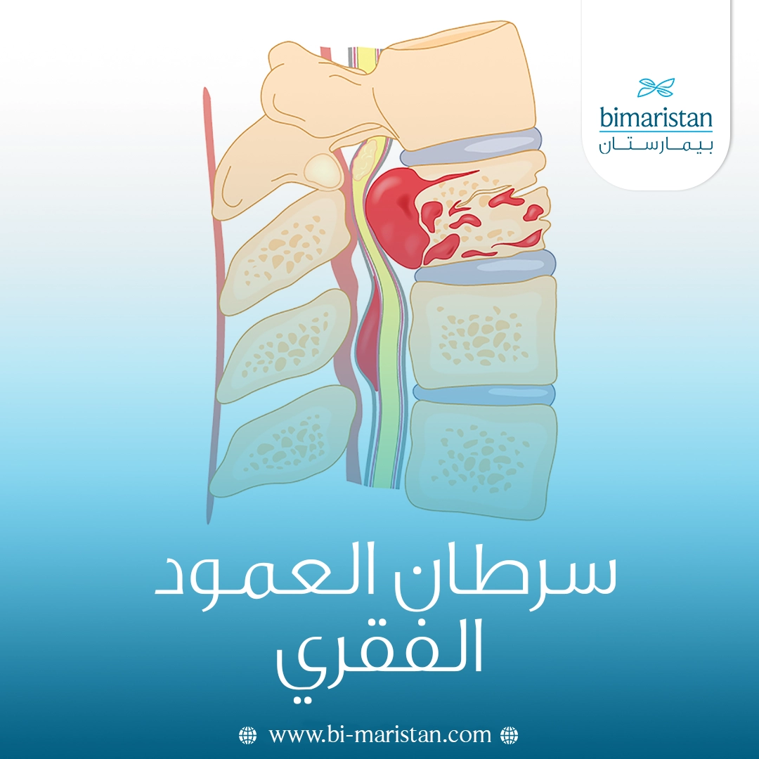 سرطان العمود الفقري