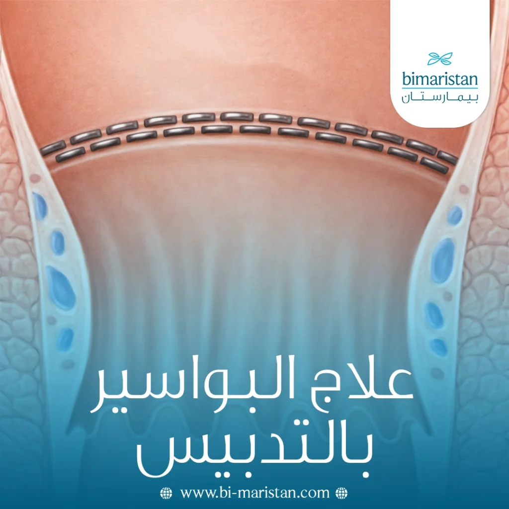 علاج البواسير بالتدبيس: مزايا العملية والتكلفة 7 علاج البواسير بالتدبيس