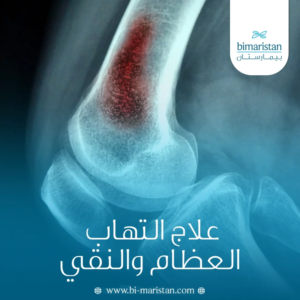 علاج التهاب العظام والنقي