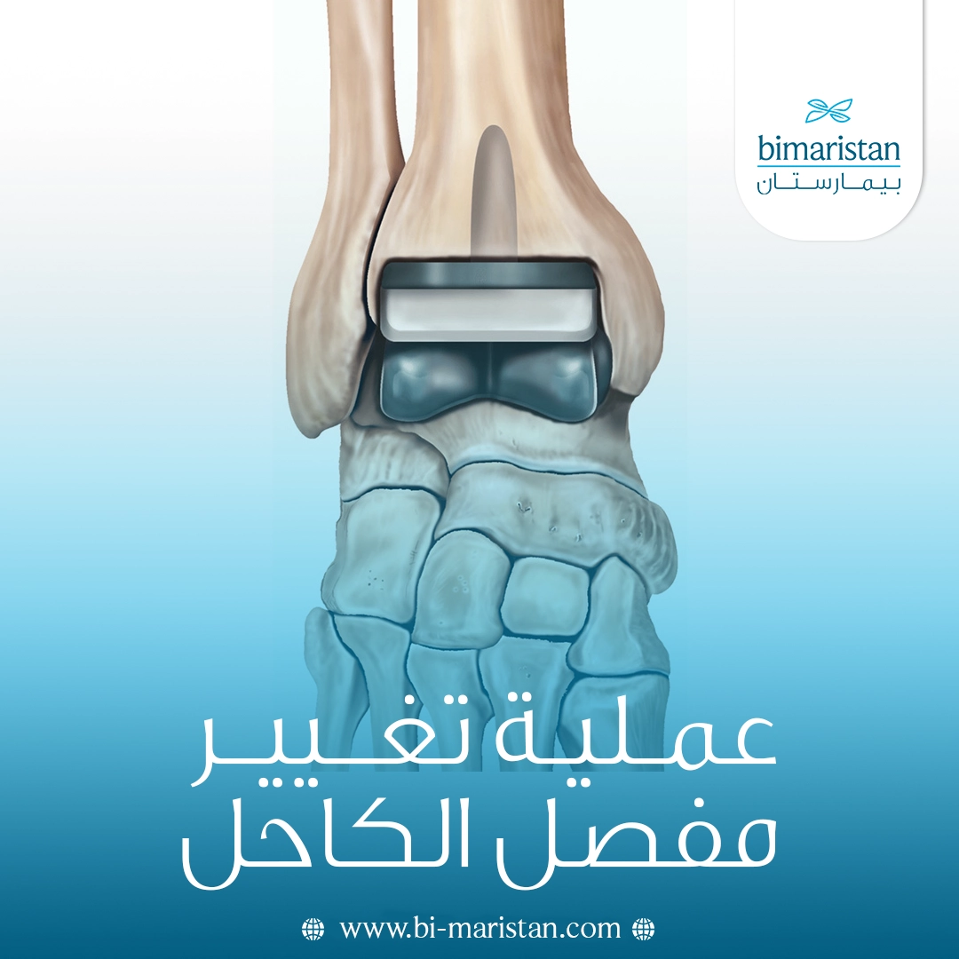 عملية تغيير مفصل الكاحل