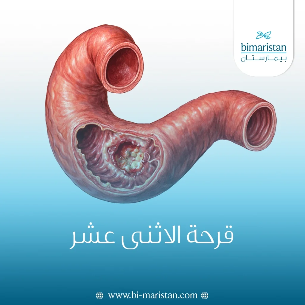 قرحة الاثنى عشر