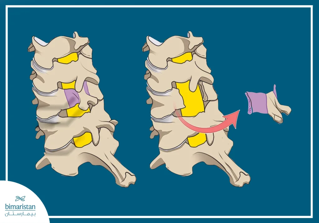 مرض الفقار اللاصق: عدو العمود الفقري المستتر 5 صورة توضح استئصال الصفيحة الفقرية لتخفيف الضغط العصبي في مرض الفقار اللاصق