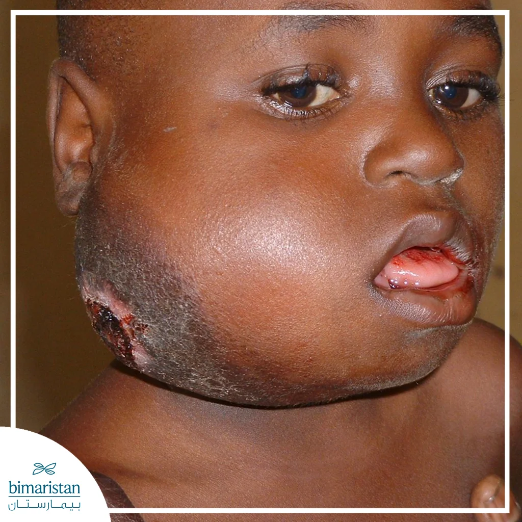 لمفوما لا هودجكن: الدليل الشامل 2026 6 صورة توضح الإصابة بلمفوما بوركيت (لمفوما لا هودجكن)