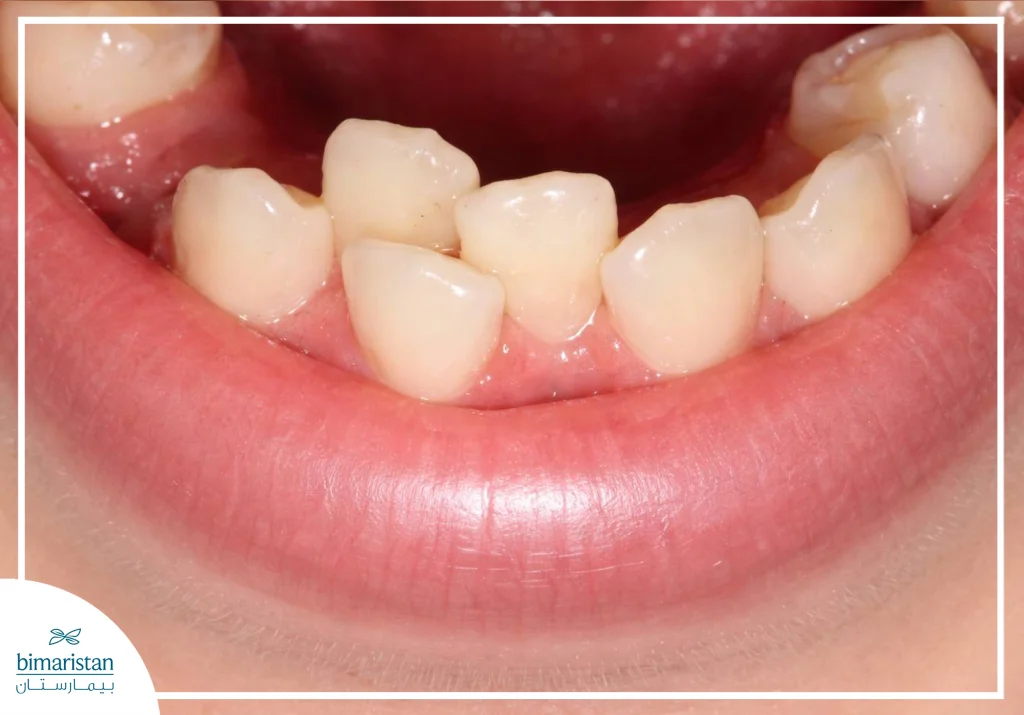 صورة توضح الازدحام في الأسنان وهو من استطبابات استعمال التقويم