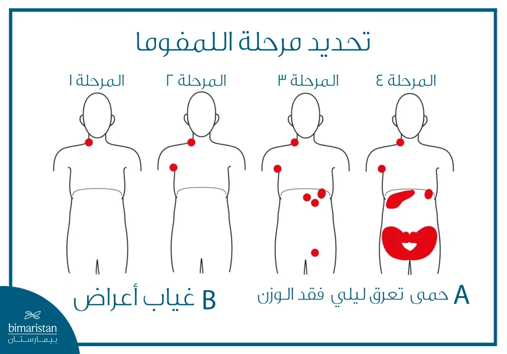 لمفوما هودجكن: الدليل الطبي الشامل من التشخيص للعلاج 7 صورة توضح التصنيف المرحلي للمفوما هودجكن