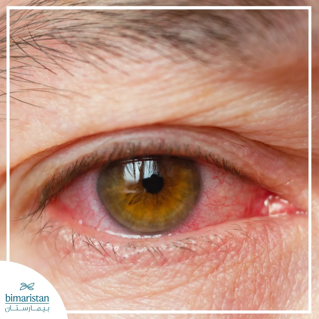 مرض الفقار اللاصق: عدو العمود الفقري المستتر 3 صورة توضح التهاب القزحية أحد أعراض مرض الفقار اللاصق