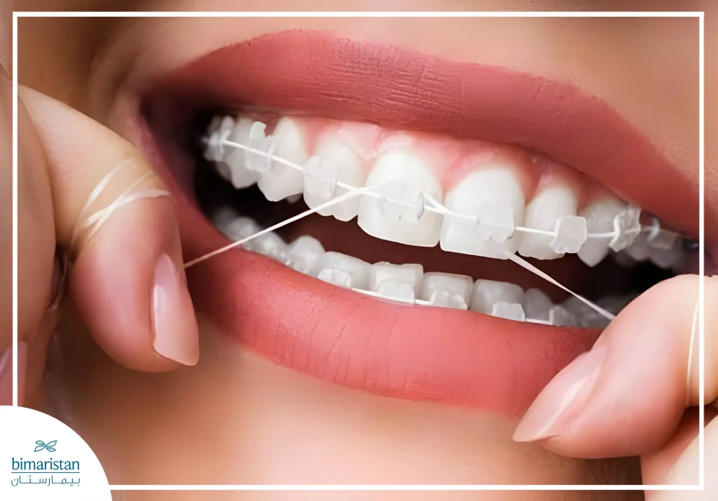 صورة توضح العناية بالأسنان والتقويم عن طريق استعمال الخيط بين السني