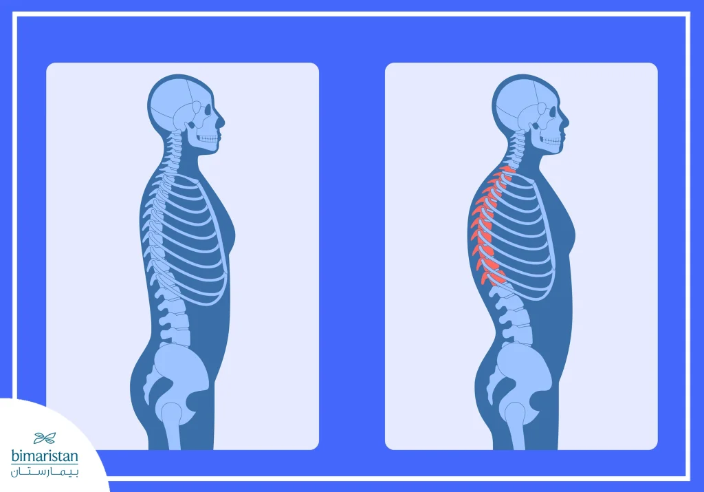 مرض الفقار اللاصق: عدو العمود الفقري المستتر 4 صورة توضح الفرق بين العمود الفقري الطبيعي والتحدّب الصدري أحد أعراض مرض الفقار اللاصق