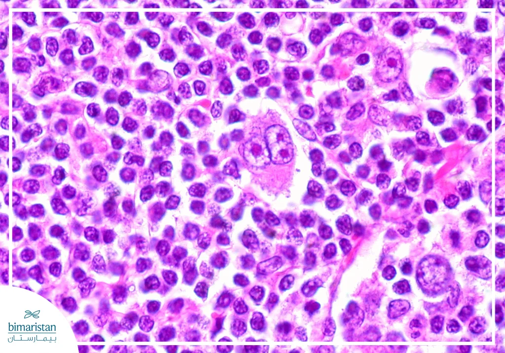 لمفوما هودجكن: الدليل الطبي الشامل من التشخيص للعلاج 6 صورة توضح خلايا ريد – ستيرنبرغ التي تميز لمفوما هودجكن