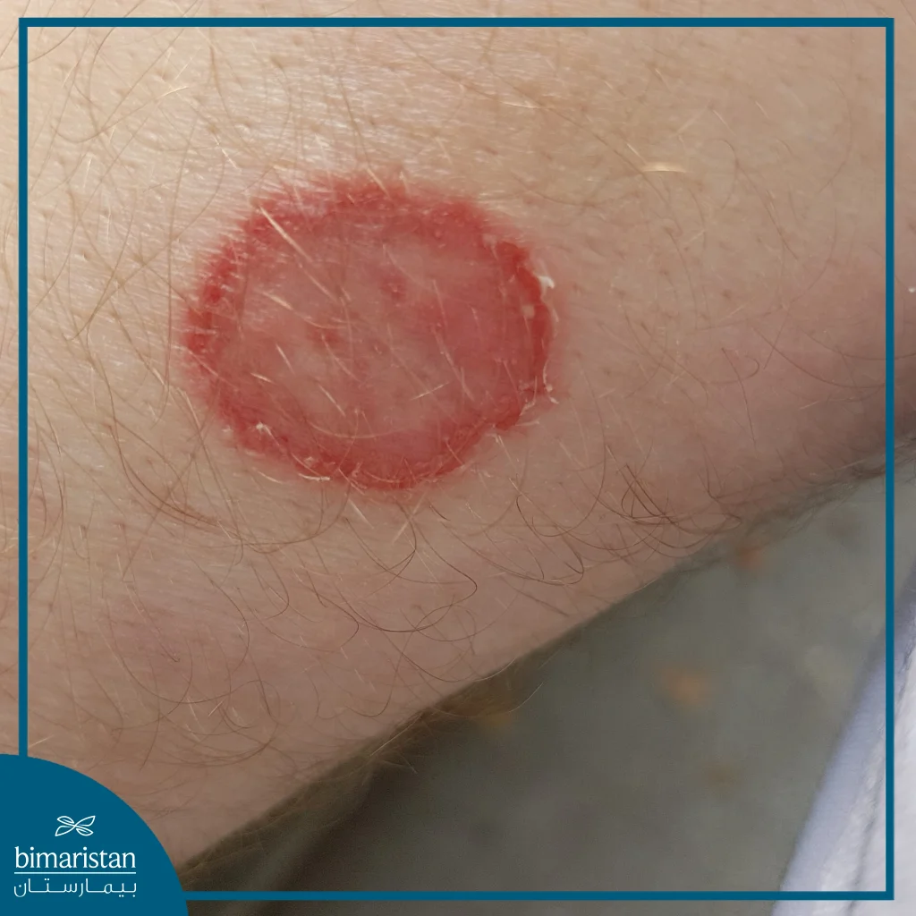 لمفوما لا هودجكن: الدليل الشامل 2026 7 صورة توضح داء الفطار الفطري أحد أنماط اللمفوما التائية الجلدية لمفوما لا هودجكن