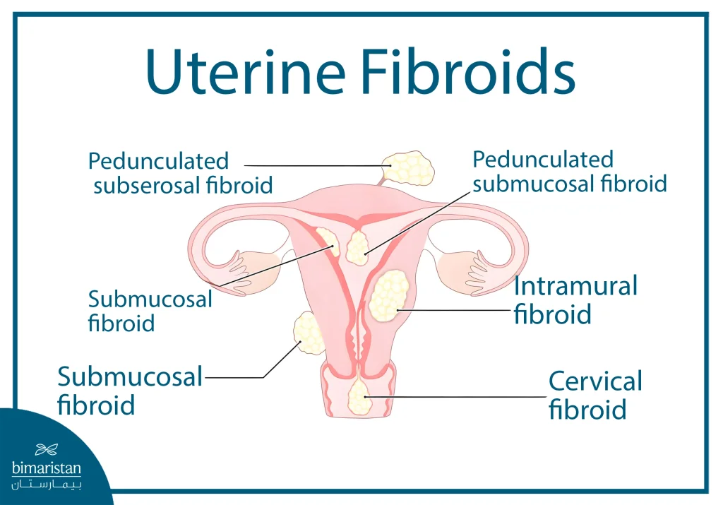 Illustration Showing Different Types Of Uterine Fibroids Based On Their Location, Including Intramural, Submucosal, Subserosal, Pedunculated Fibroids, And Cervical Fibroids, With A Clear Anatomical View Of The Uterus.
