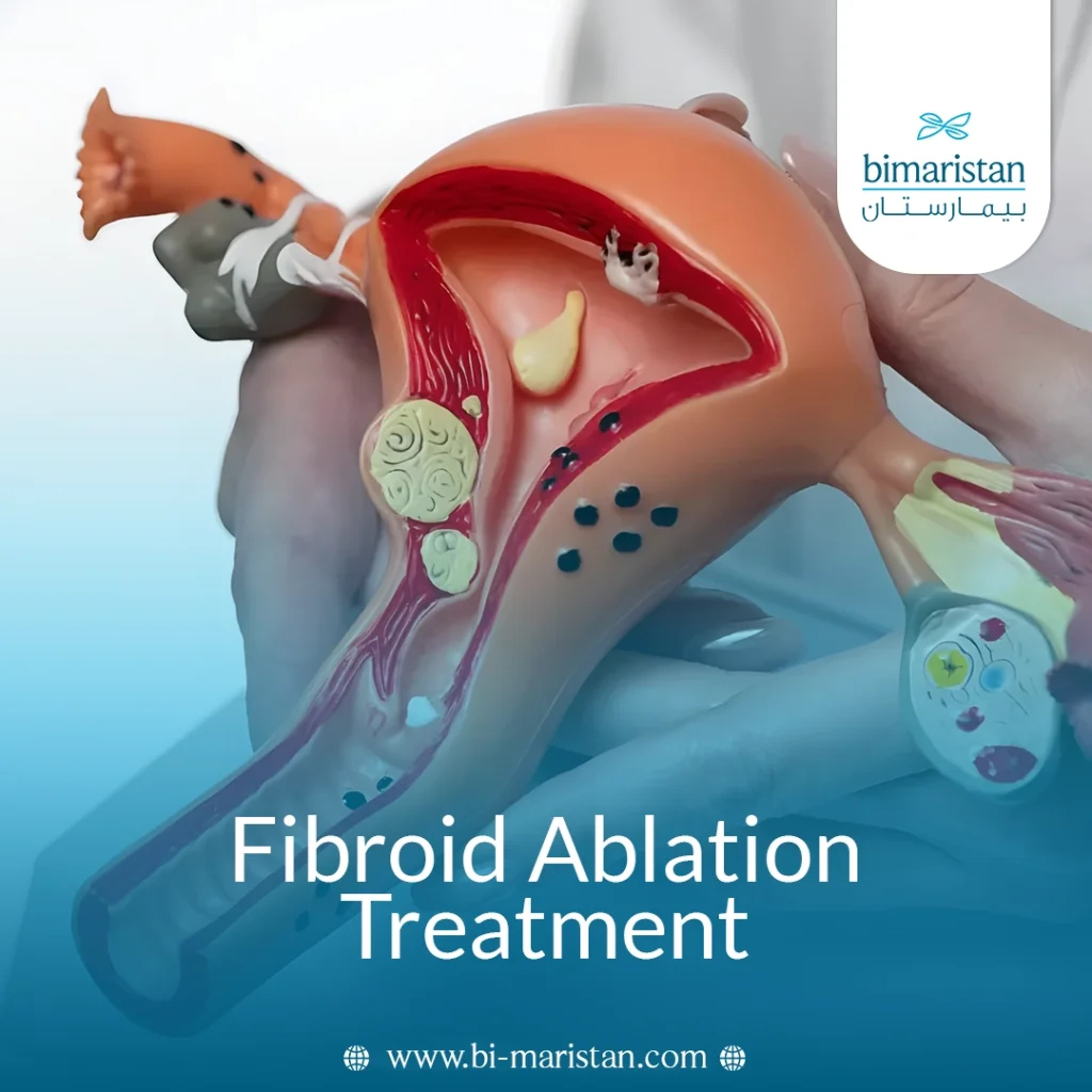 Fibroid Ablation Treatment