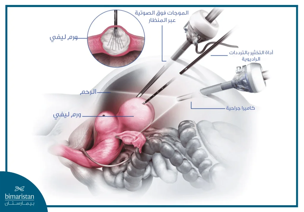 التخثير الحراري لعلاج الورم الرحمي الليفي: متى يكون الخيار الأنسب؟ 4 توضّح الصورة إجراء التخثير بالترددات الراديوية لعلاج الورم الرحمي الليفي باستخدام منظار بطني، حيث يتم إدخال مسبار خاص إلى داخل الورم الليفي تحت توجيه الموجات فوق الصوتية، مع استخدام كاميرا جراحية لضمان الدقة والحفاظ على الأنسجة السليمة المحيطة.