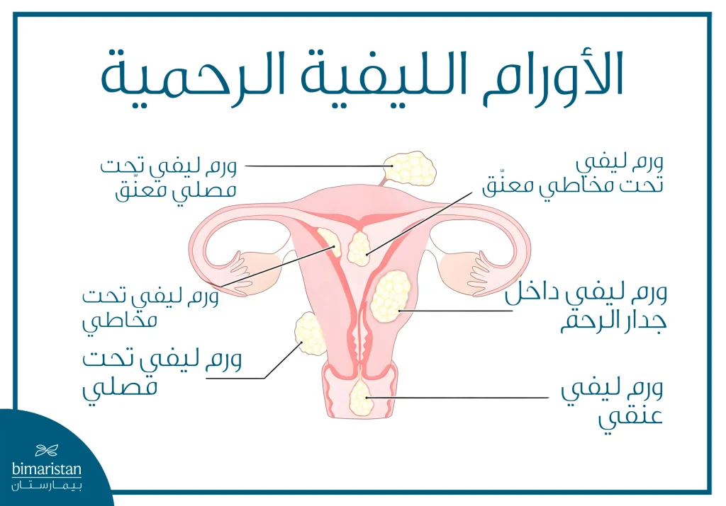 التخثير الحراري لعلاج الورم الرحمي الليفي: متى يكون الخيار الأنسب؟ 2 توضّح الصورة الأنواع المختلفة للورم الرحمي الليفي حسب موقعه داخل الرحم، بما في ذلك الأورام الليفية داخل الجدار، وتحت المخاطية، وتحت المصلية، والأورام الليفية المعنّقة، إضافة إلى الأورام الليفية العنقية، مع رسم تشريحي يبيّن علاقتها بتجويف الرحم والأنسجة المحيطة.