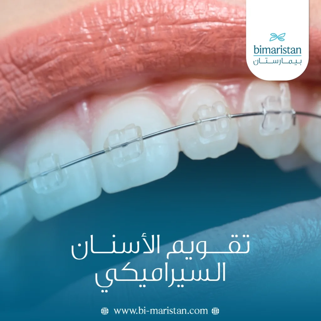 تقويم الأسنان السيراميكي