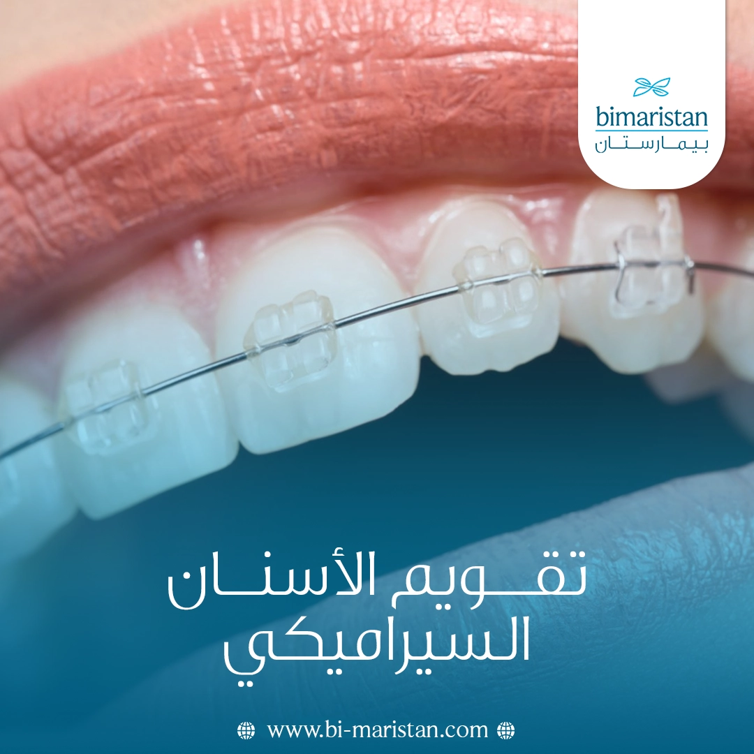 تقويم الأسنان السيراميكي