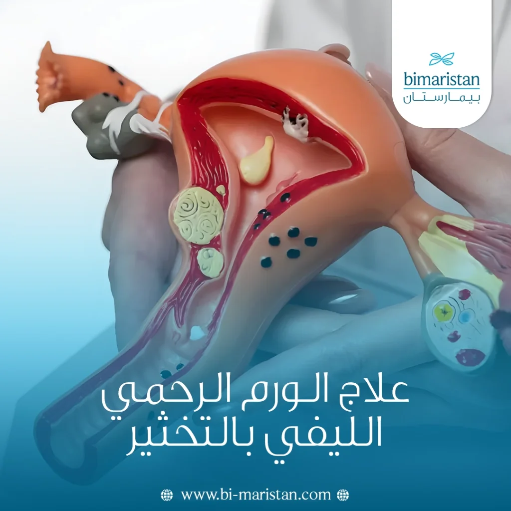 التخثير الحراري لعلاج الورم الرحمي الليفي: متى يكون الخيار الأنسب؟ 5 علاج الورم الرحمي الليفي بالتخثير