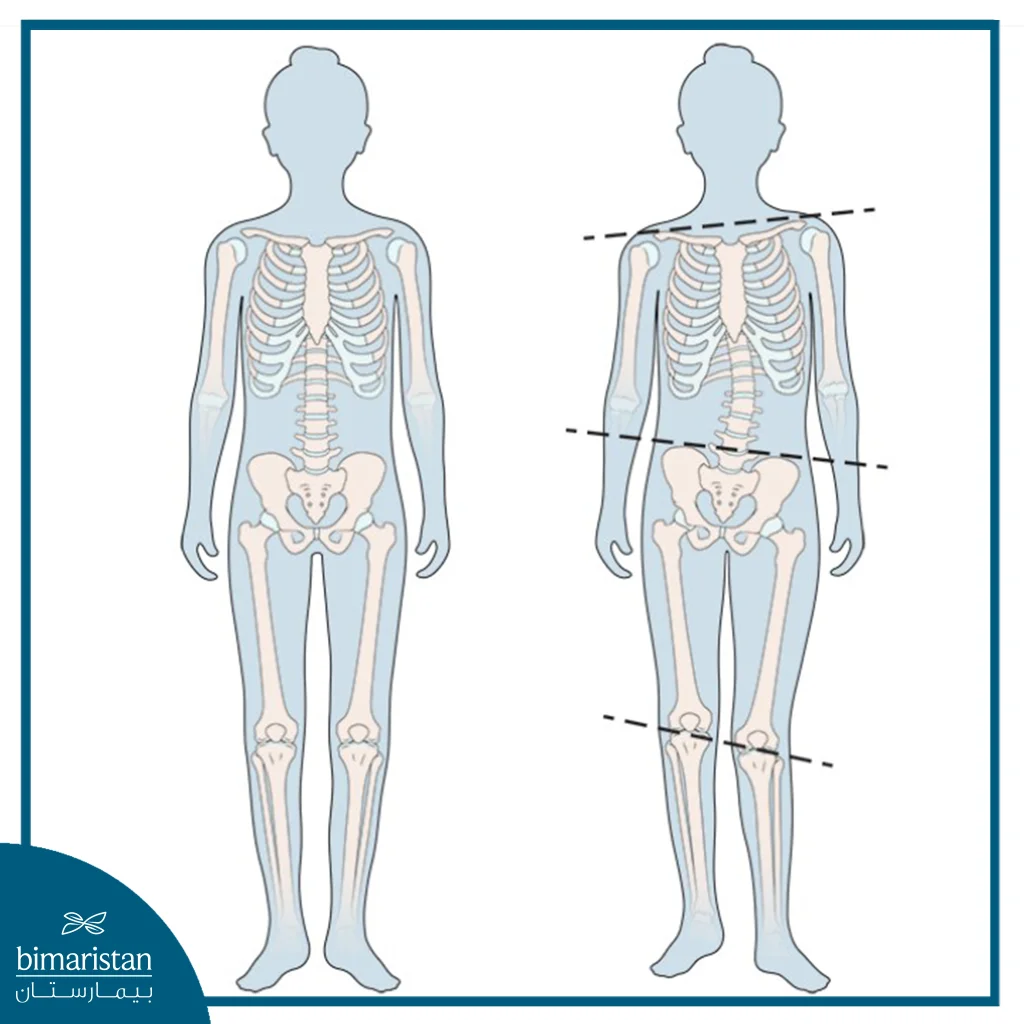تقنية المسمار النخاعي (Fitbone) لإطالة العظام: كل ما تحتاج معرفته 14 اختلاف طول الساقين أحد أهم أسباب إجراء عملية فيتبون