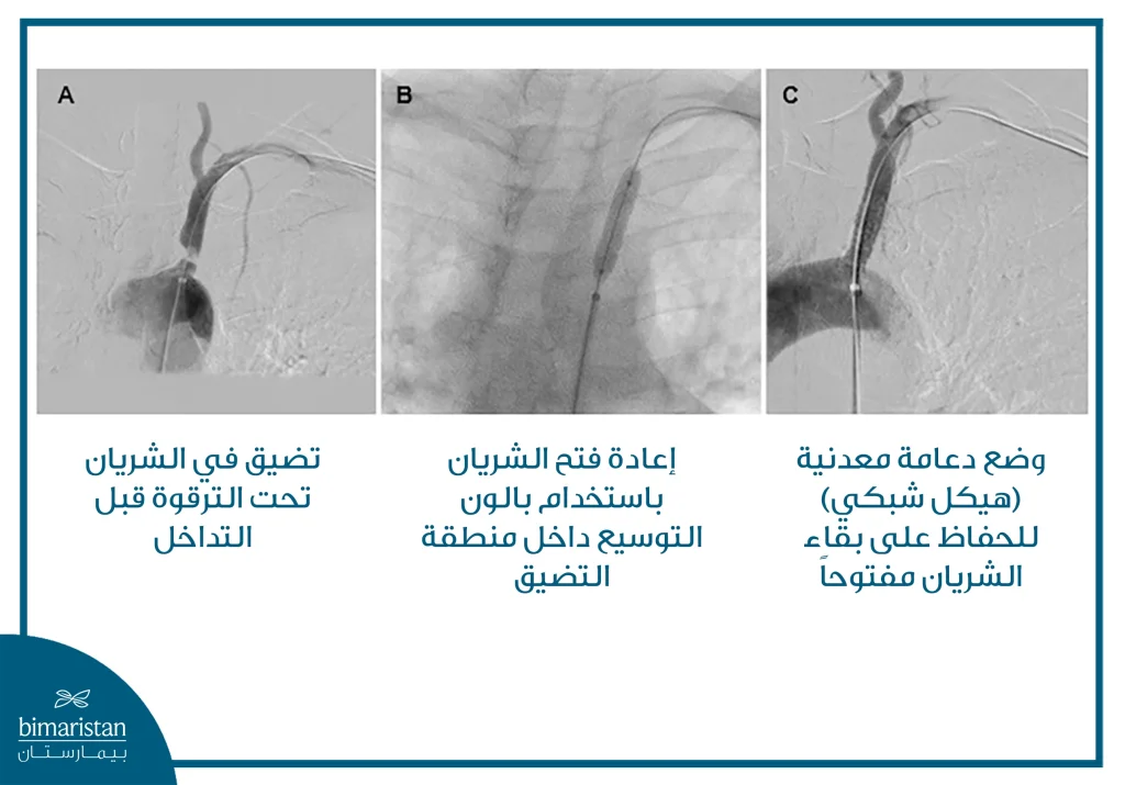 تُظهر الصور (A–C) تسلسلاً لإجراء توسيع الشريان تحت الترقوة بالبالون مع وضع دعامة معدنية لإعادة فتح الوعاء وتحسين الجريان الدموي.












