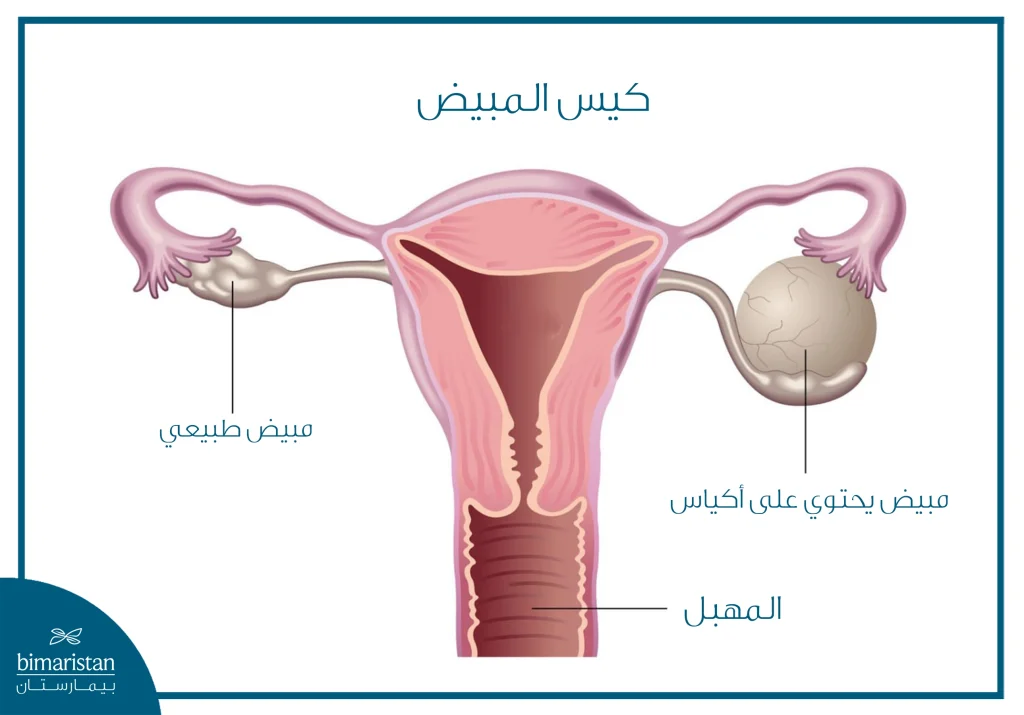رسم تشريحي يوضح الفرق بين مبيض طبيعي ومبيض يحتوي على كيس.