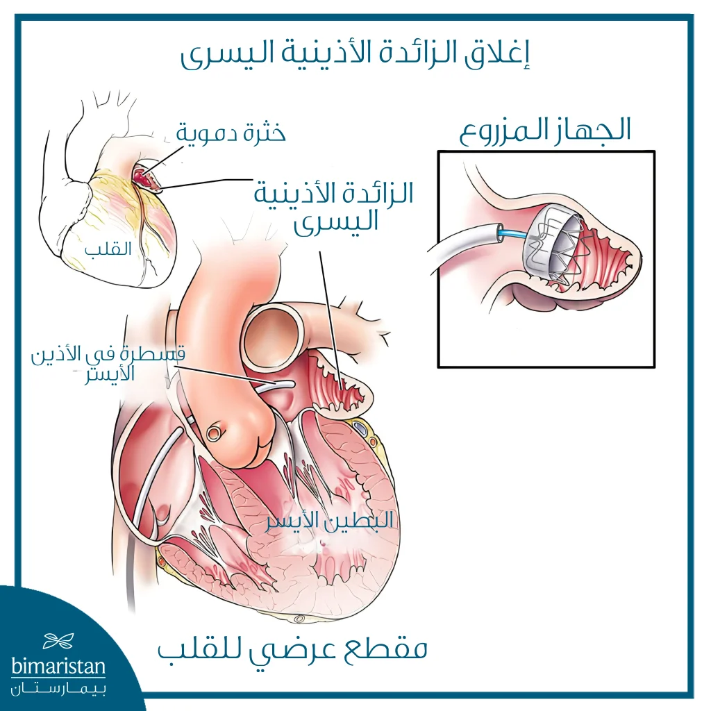 رسم طبي يوضح مقطعاً عرضياً للقلب أثناء إجراء إغلاق الزائدة الأذينية اليسرى بالقسطرة، مع إظهار الخثرة والجهاز المزروع داخل الزائدة