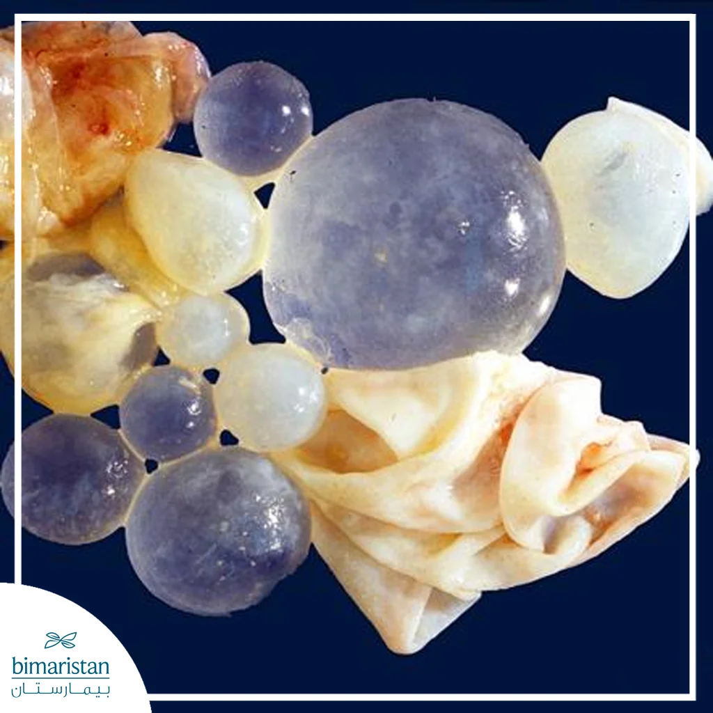 علاج الكيس المائي في الكبد (داء المشوكات) 6 شكل الكيس المائي في داء المشوكات بعد إزالته جراحياً