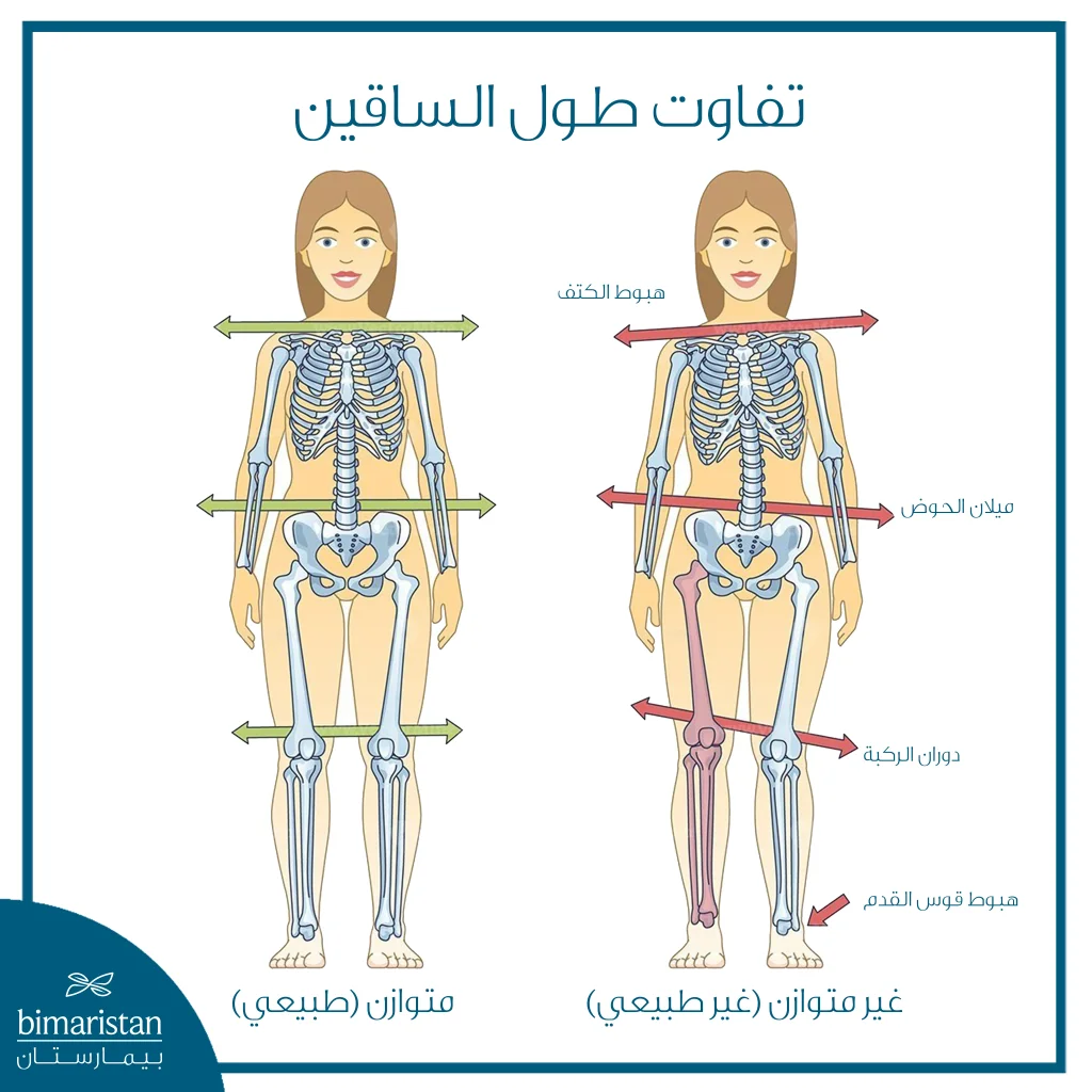 تقنية برسايس 2: كل ما تريد معرفته 14 صورة بسيطة توضح حالة اختلاف طول الأطراف