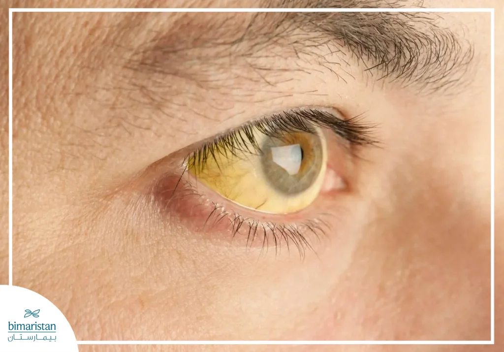 صورة توضح اصفرار العين (اليرقان) كأحد أعراض خراج الكبد
