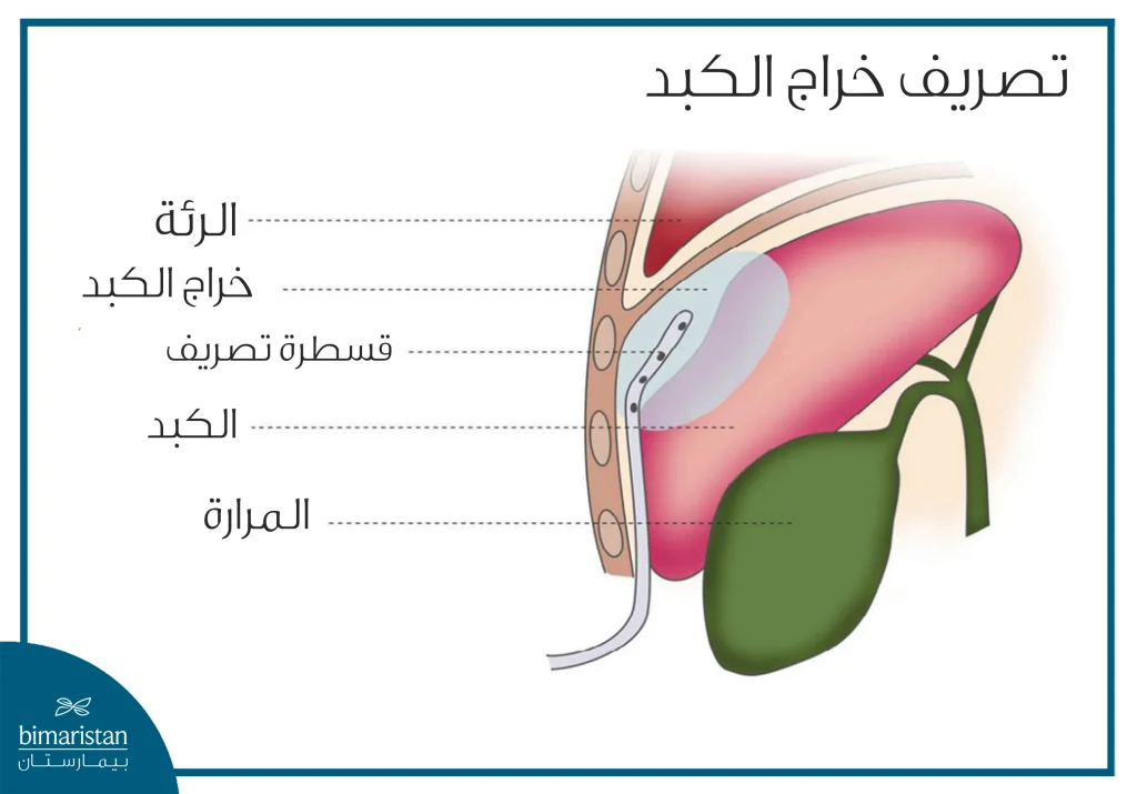 صورة توضح عملية تصريف خراج الكبد عبر الجلد