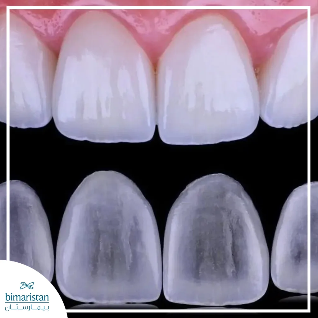 صورة توضح لومينير الأسنان