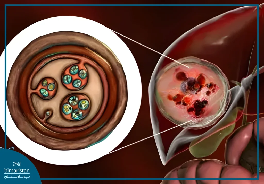 علاج الكيس المائي في الكبد (داء المشوكات) 4 صورة توضح وجود الكيس المائي (داء المشوكات) في الكبد وبداخله كيسات بنات وسائل