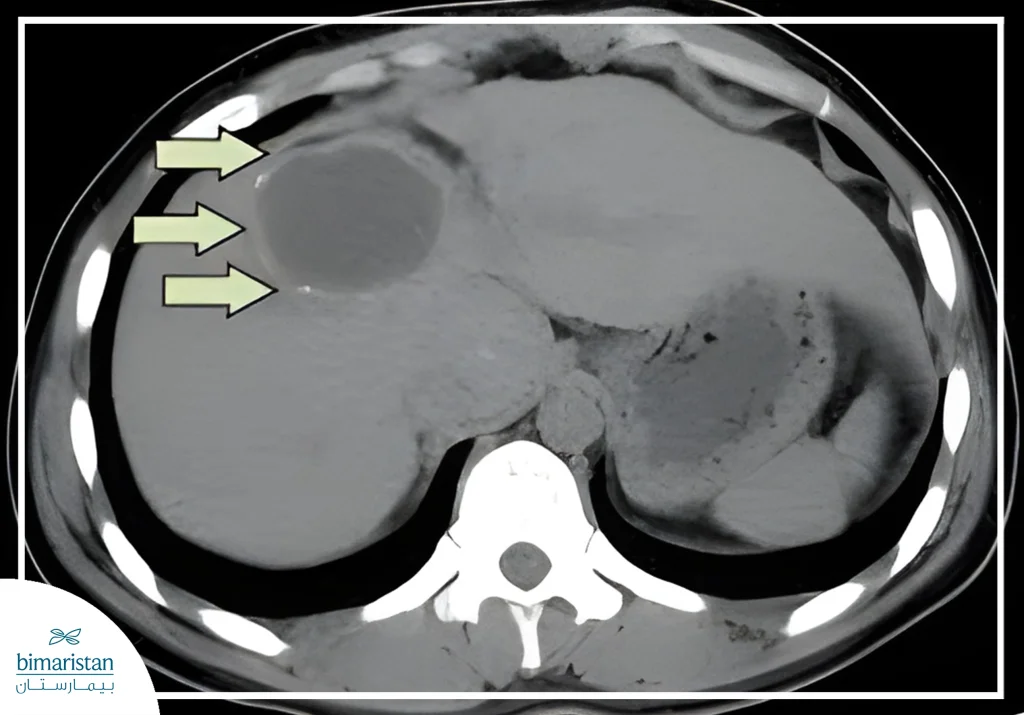 علاج الكيس المائي في الكبد (داء المشوكات) 5 صورة توضح وجود الكيس المائي في الكبد (داء المشوكات) على التصوير الطبقي المحوري