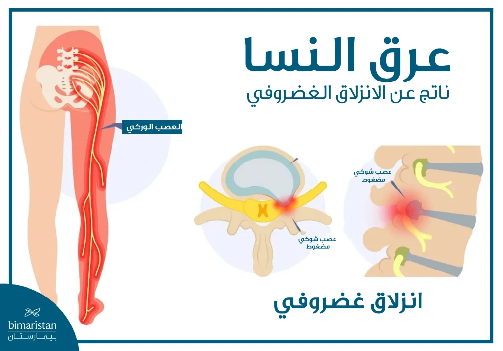 علاقة عرق النسا والانزلاق الغضروفي بالطرف السفلي