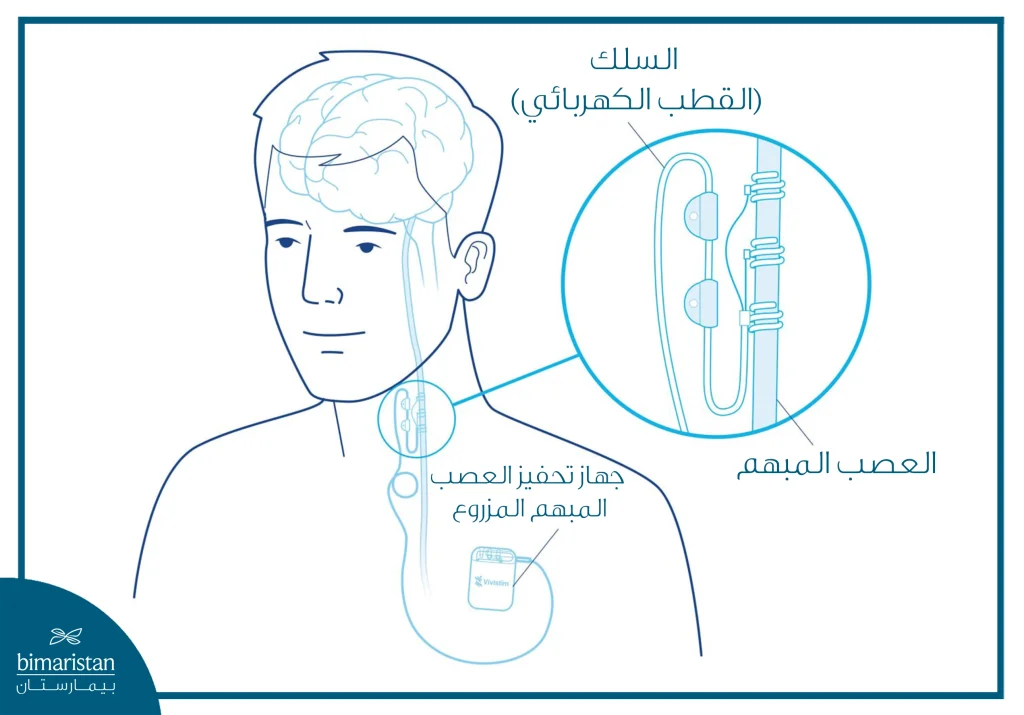 عملية زرع الجهاز