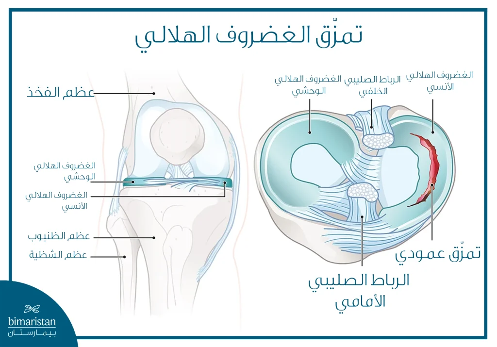 كل ما تريد معرفته عن إصابات الغضروف المفصلي