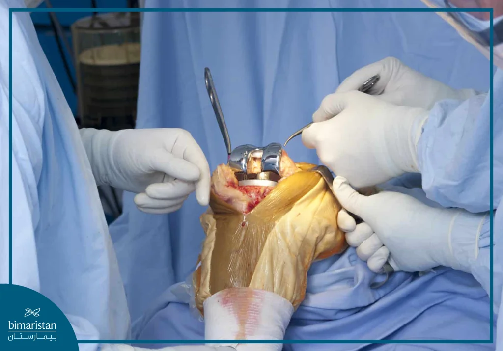 كل ما تريد معرفته عن استبدال مفصل الركبة