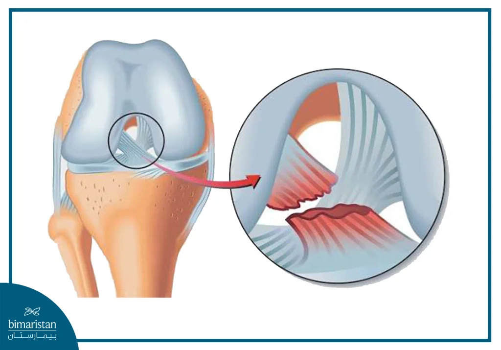 كل ما تريد معرفته عن الرباط الصليبي الأمامي وإصاباته