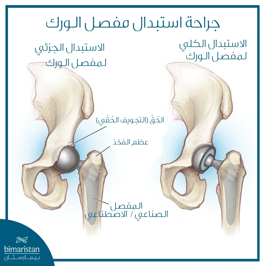 كل ما تريد معرفته عن جراحة مفصل الورك
