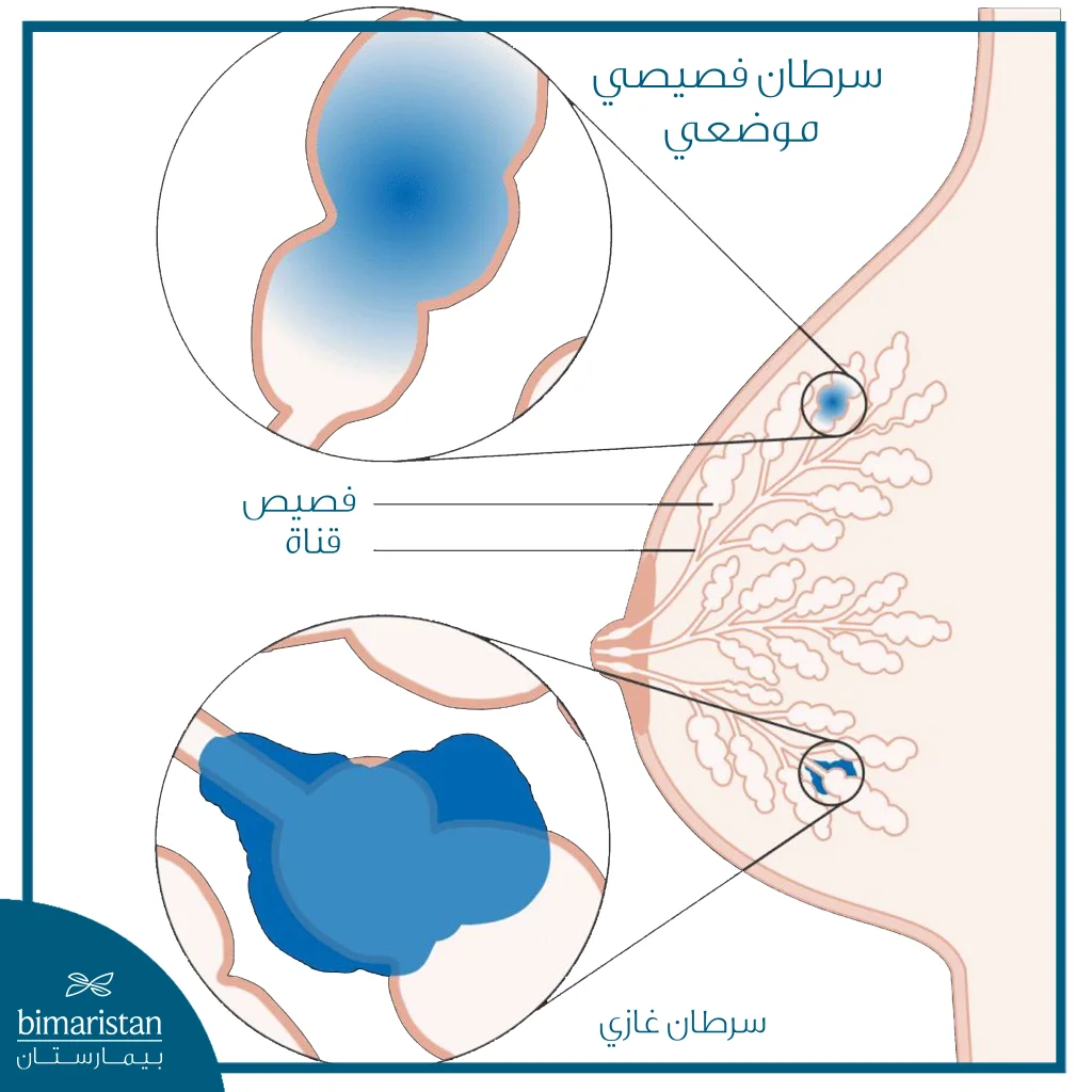 كل ما تريد معرفته عن سرطان الثدي